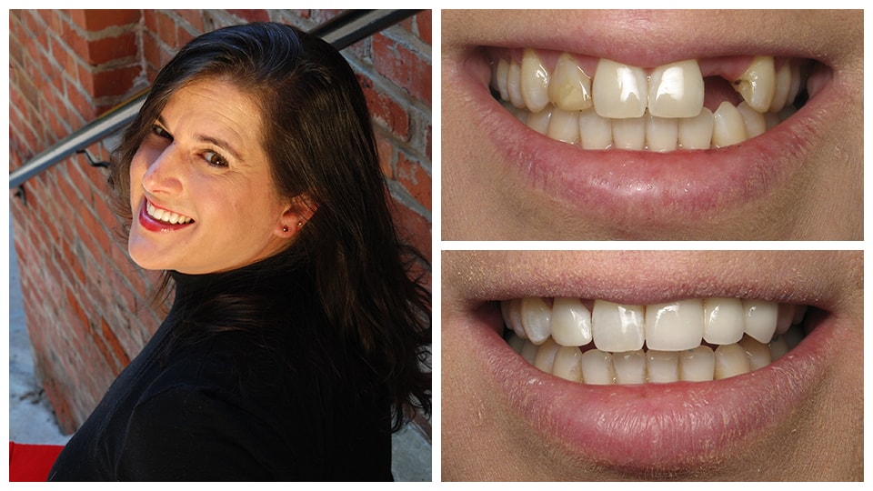 Before and after smiles of a Croasdaile patient with a smile makeover