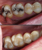 Actual patient before and after metal-free fillings