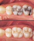 Before and after metal-free fillings with your dentists in Durham