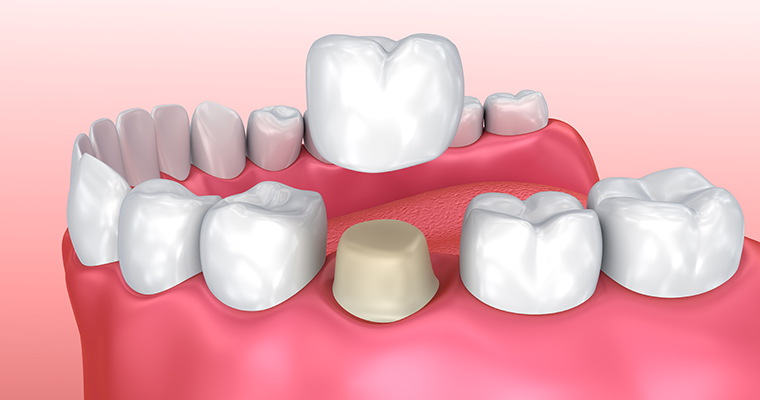 What Are CEREC Same-Day Crowns?