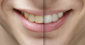 Zoom teeth whitening can lighten teeth up to eight shades.