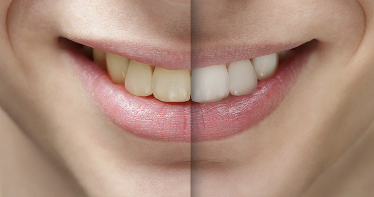 Close-up of teeth. Divided image showing before and after a whitening treatment.