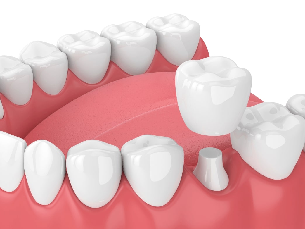 Do dental crowns really hurt?
